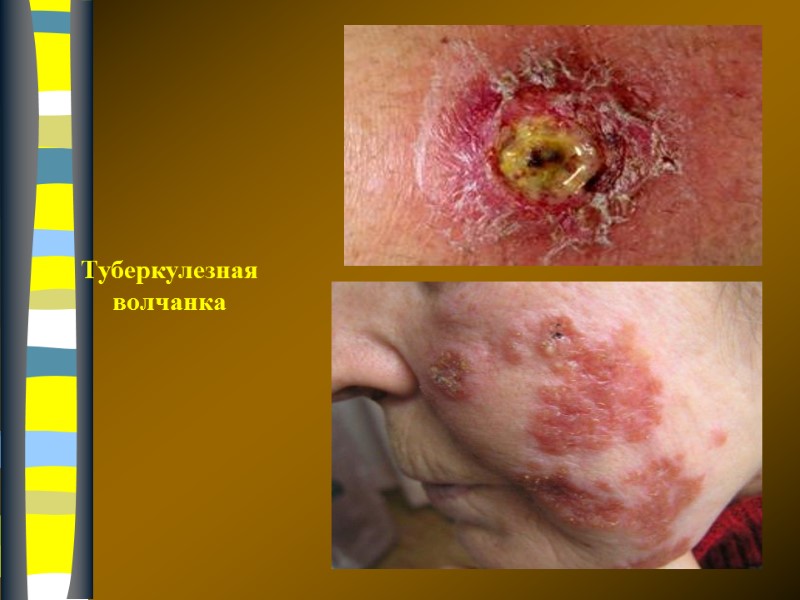 Туберкулезная волчанка